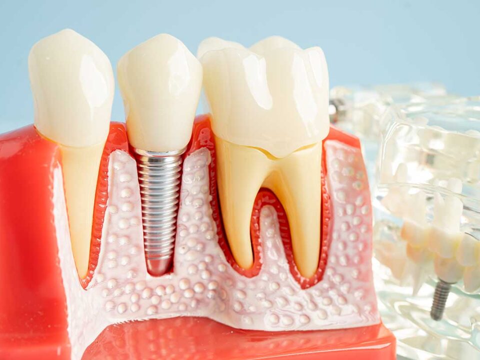 3d model of an implant in between two healthy teeth to show the signs and symptoms of peri-implantitis