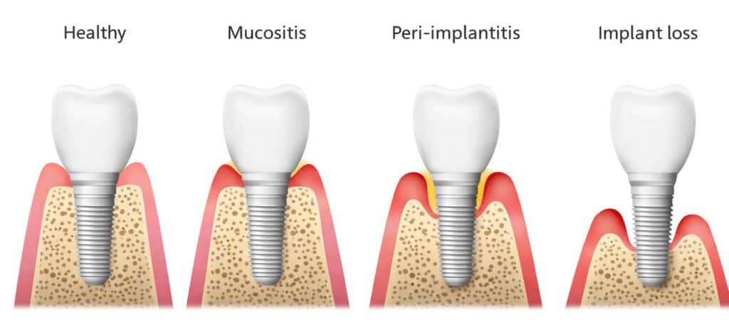 image showing what the different stages of gum health can look like after a dental implant procedure