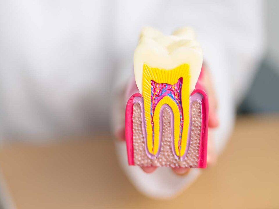 dentist holds a 3d model of a tooth cross section to show what happens if you delay getting a cavity filled.