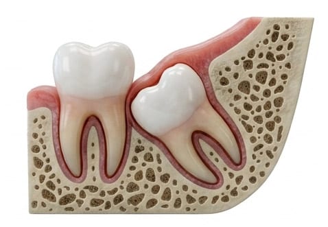Angled impacted wisdom tooth