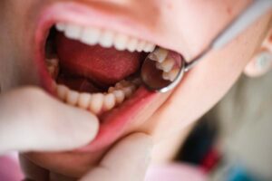 dentist inspects a patients mouth for dry socket after a wisdom tooth extraction