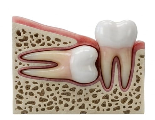 Horizontal impacted wisdom tooth