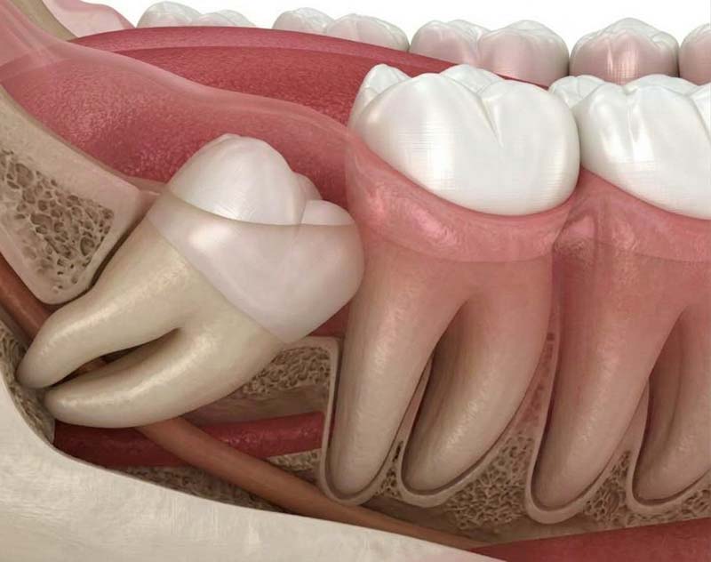 Impacted wisdom tooth angled against the neighbouring molar on an X-ray