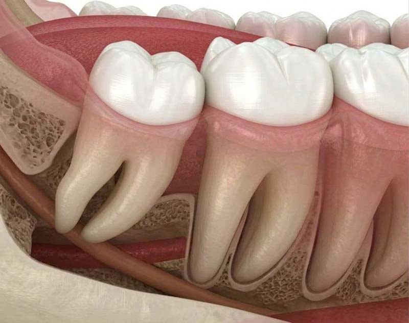 Healthy wisdom tooth erupted in good position next to the molars