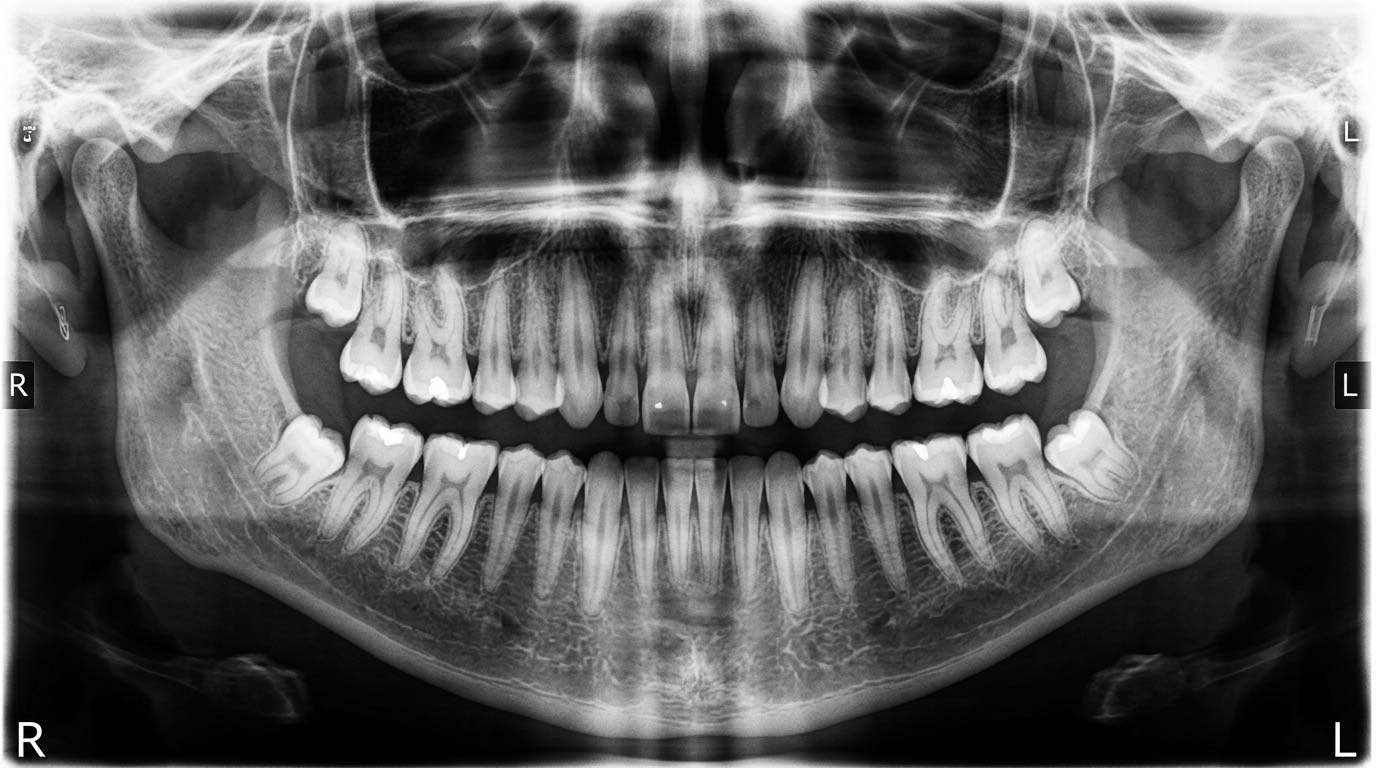 Panoramic X-ray used to assess wisdom teeth before removal