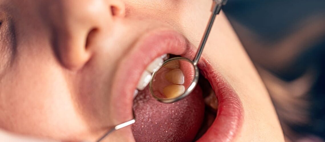 photo of a patients open mouth as our hamitlon dentist works on a cavity using the atraumatic restorative treatment (ART) option