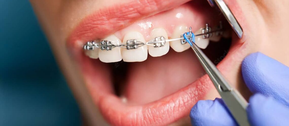 woman is having her braces adjusted by a dentist after she raised the question of can braces or aligners move teeth too fast
