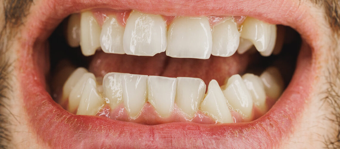 man showing a chipped tooth wondering what to do about it