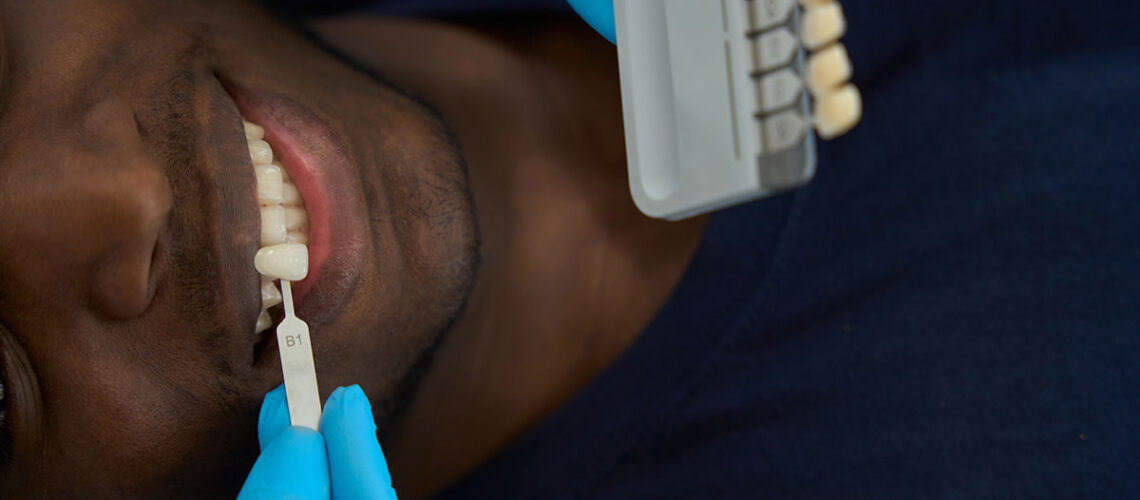 man at the dentist having veneers test fitted after discussing which option - dental crowns vs onlays vs veneers - would be best for his case