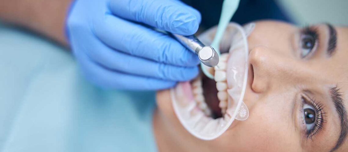 woman having a dental fillings installed to fix a cavity