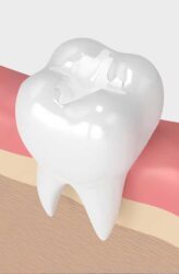 dental-fillings-hamiltom-martindale-dental2