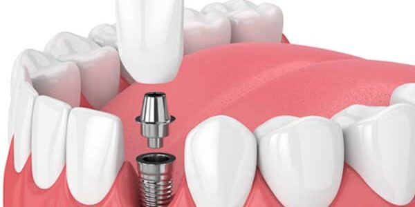 dental-implants-faq