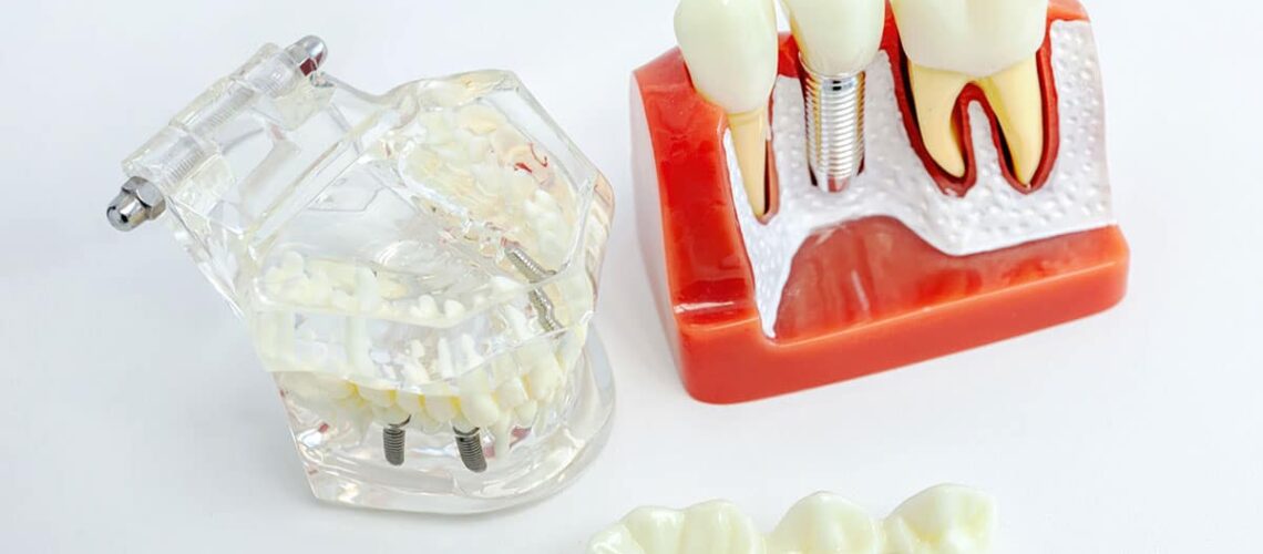 this is the featured image for our dental implants vs dental bridges article showing a set of bridges next to an implant model so patients can see the visual differences