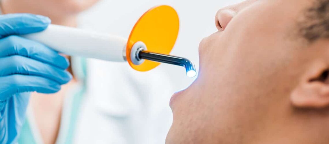 image of a man having dental sealants applied to his teeth. image is showing the UV light hardening process taking place.