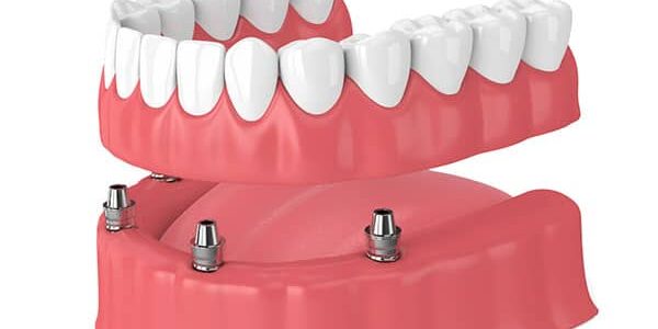 dentures-faq-(2)