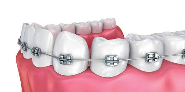 orthodontics-faq