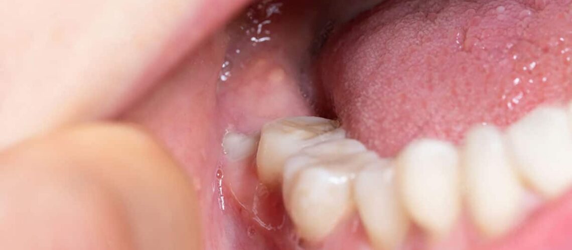 mouth full of saliva as the featured image of the role of saliva in oral health article