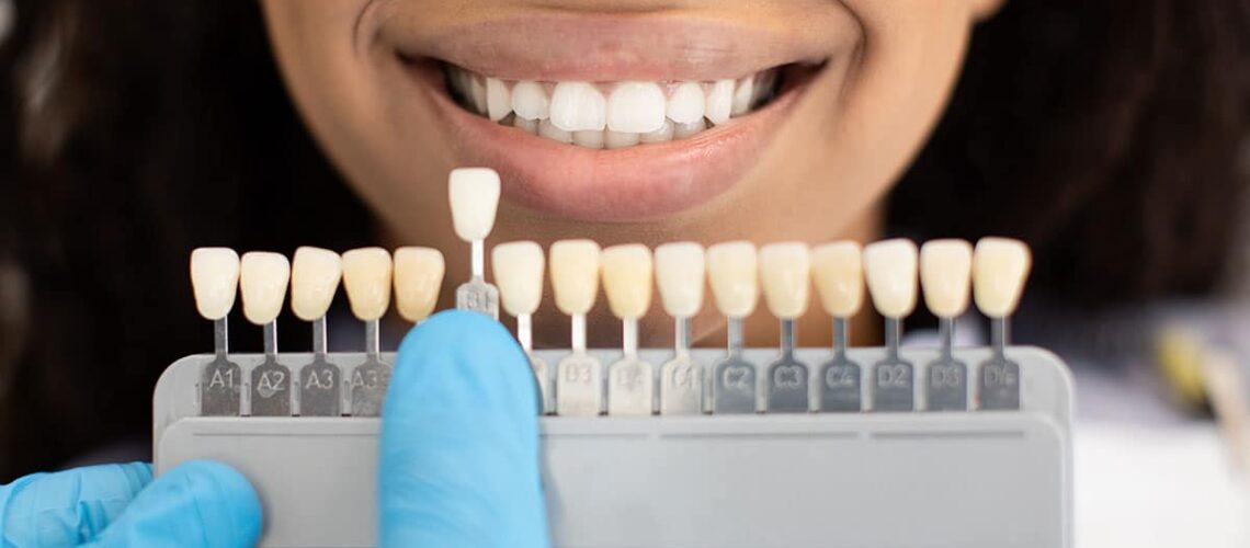 woman is having her teeth shade checked as she considers the question should you whiten teeth before restorations