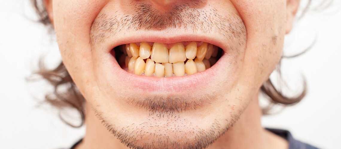 a man shows his yellowed teeth which were caused by smoking cigarettes